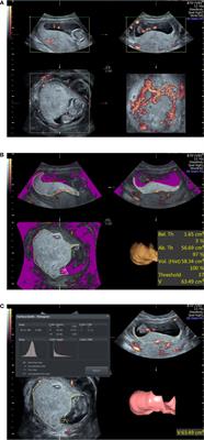 Investigation Into the Predictive Potential of Three-Dimensional Ultrasonographic Placental Volume and Vascular Indices in Gestational Diabetes Mellitus